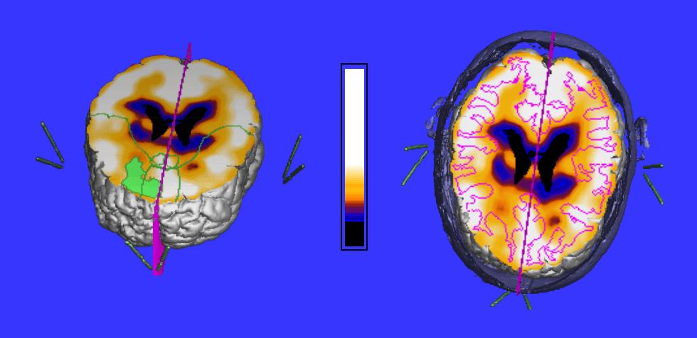 7 Multimodal cutplane visualization of a plane through the frontal lobe tumor area, with a voxel gradient shaded rendering of the cortex from MRI T1 as a reference frame.