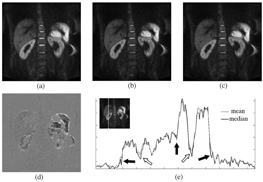 Figure 1. Diffusion-weighted images (b = 250 s mm 2 ) for healthy volunteer using (a) mean, (b) median, and (c) trimmed mean.