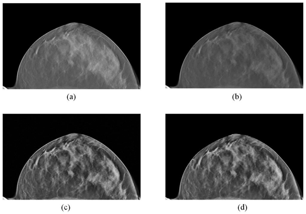 Qin et al. Page 11 Figure 3. The pre-processing results of the DBT image. (a) Original image.