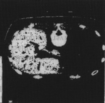 Fig.7 Binary image obtained with the gray-level thresholding method. In the case of classification of myocardial heart diseases, The ANNs were trained by BP- and GA-method.