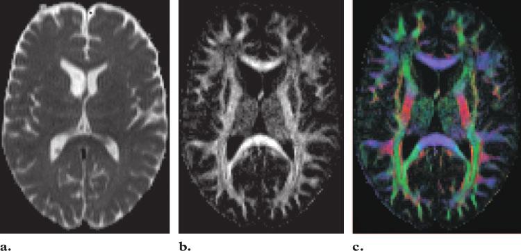 RG f Volume 26 Special Issue Hagmann et al S217 Figure 16. Extraction of scalar values from diffusion tensor imaging. (a) Image shows mean diffusion, which is the trace of the diffusion tensor.
