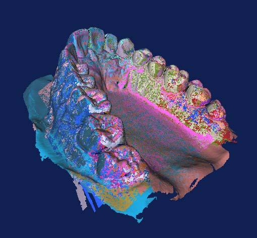 Two partial scans of a jaw plaster cast are presented in Figure 4.