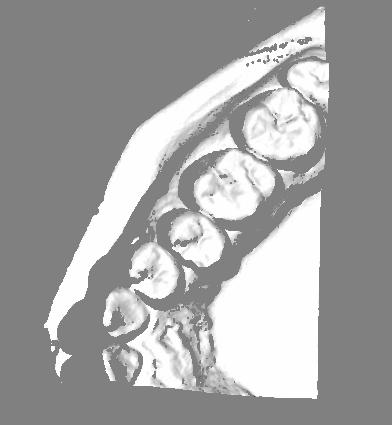 The mean error of scan merging is at the level of 0.0 mm. Figure 6. Jaw 3D model in single mesh form 4.