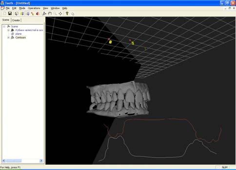 5. OCCLUSION ANALYSIS Jaws 3D models installed in the position according their real occlusion allow investigating how hidden teeth surfaces are relatively located, this being important for teeth
