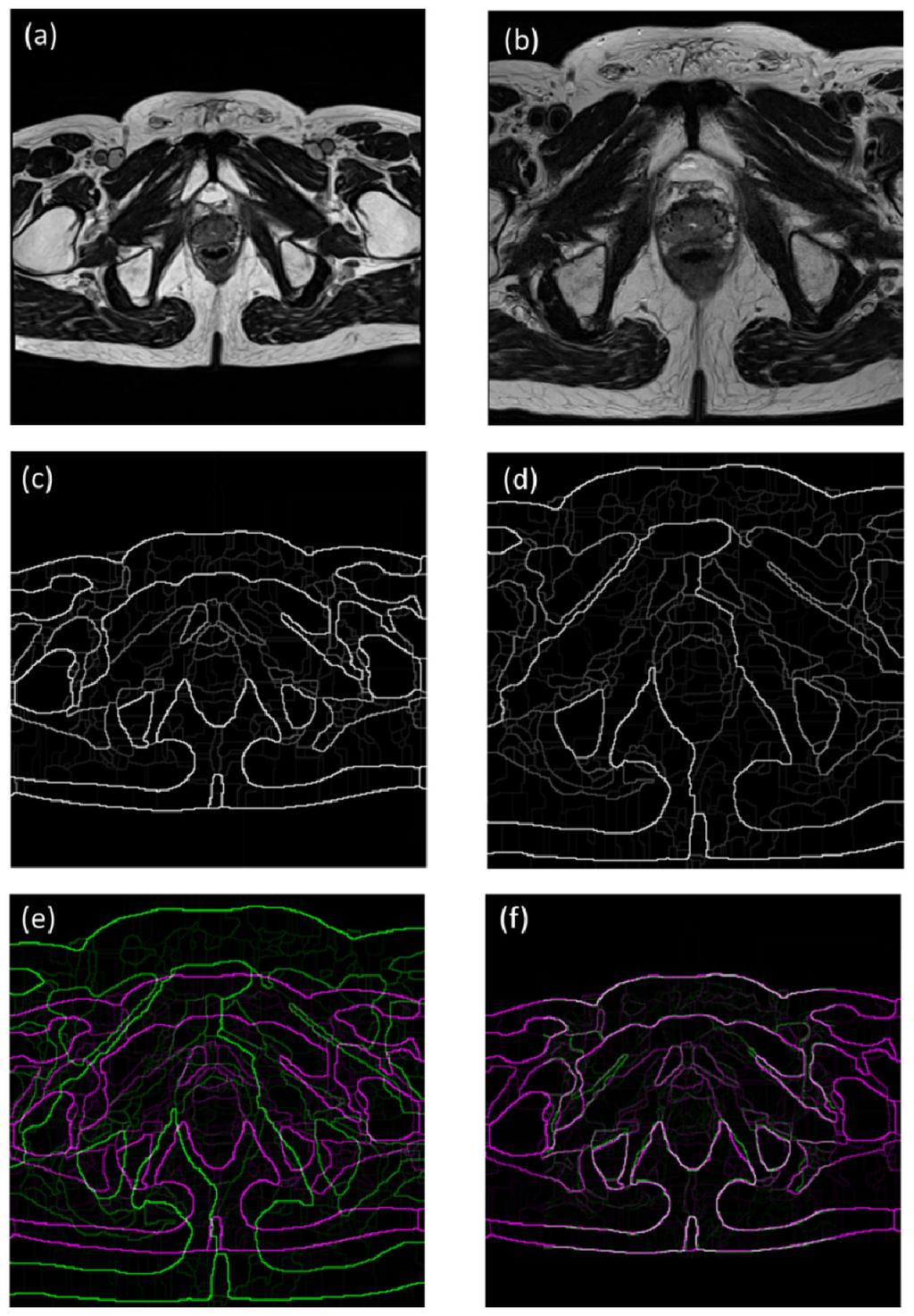 Tian et al. Page 8 Figure 2. The demonstration of the edge maps of MR images. (a) The target image. (b) The atlas image. (c) The edge map of the target image. (d) The edge map of the atlas image.