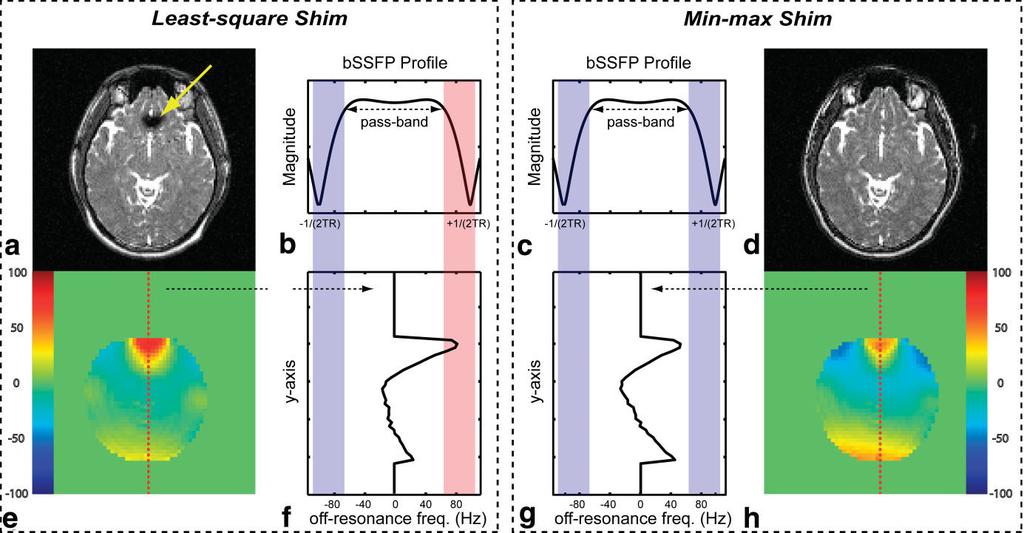 Min-Max Shimming for bssfp 1501 FIG. 1. Conceptual illustration of the advantage of the min-max shim method in bssfp imaging. a,d: The bssfp image. b,c: The bssfp magnitude profile.