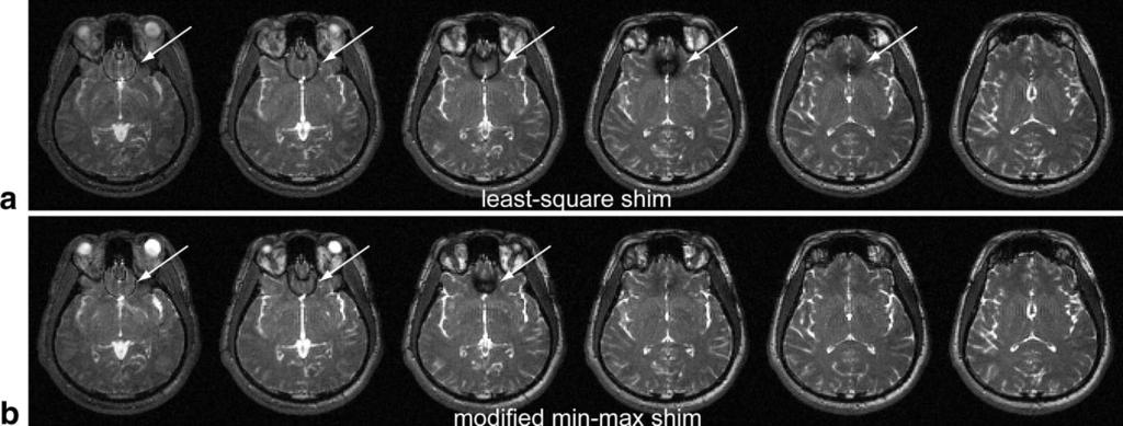 The min-max shim field map shows a reduced maximum off-resonance frequency in the frontal lobe area.