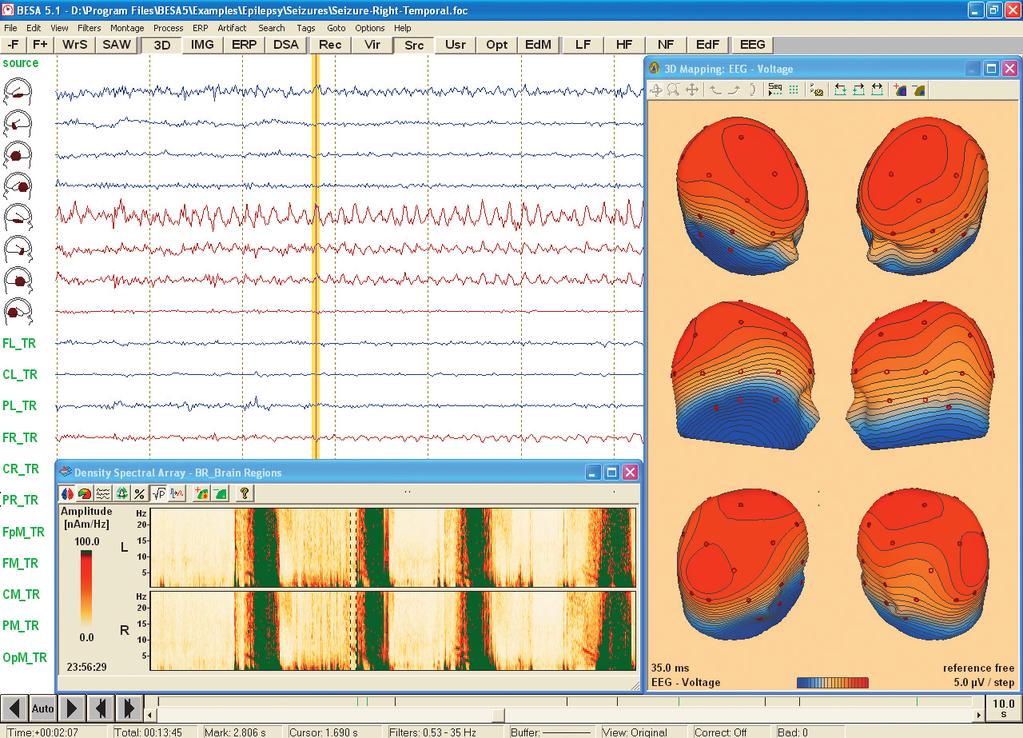 Data review and processing Source montages and 3D whole-head mapping Onset of epileptic seizure with 3D whole-head maps and hemispheric comparison of density spectral arrays (DSA) Graphical display