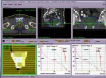 Dicom RT iplan RT Image The Global Contouring Workstation Making revolutionary tools available for existing TPS iplan RT Image Quick and consistent organ definition Automatic Image Fusion Atlas-based