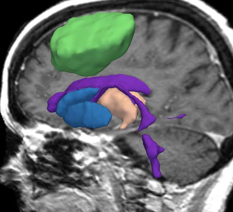 Case 1 Case 2 Case 3 Fig. 5. 3D rendering of tumor (in green), ventricles (in mauve), thalamus (in beige), and central nuclei (in blue) from the images in Figure 4.