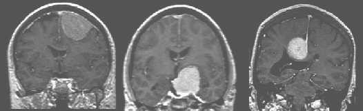 Fig. 2. SPGR T1-weighted patients with meningioma. Contrast agent is gadolinium.