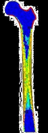 failure From left to right: segmentation of the femur from CT dataset, finite element model