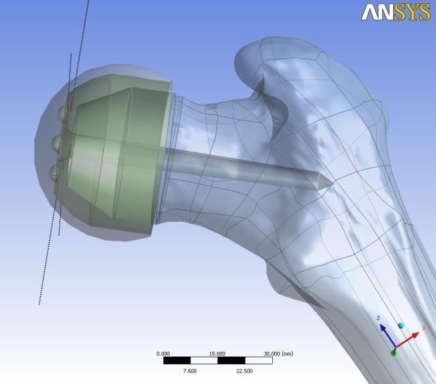 FE for Orthopedic Surgery Planning Hip Resurfacing Prosthesis Geometry and Material properties given by scan data Stresses and strains function of the prosthesis orientation angles Optimal