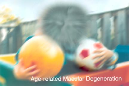 Vision Impairments Macular Degeneration Photos courtesy of National Eye Institute http://www.nei.nih.