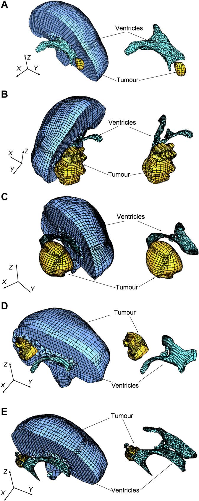 A. Wittek et al. / Progress in Biophysics and Molecular Biology 103 (2010) 292e303 295 analyst to manually build a patient-specific hexahedral mesh of the brain with a tumour.