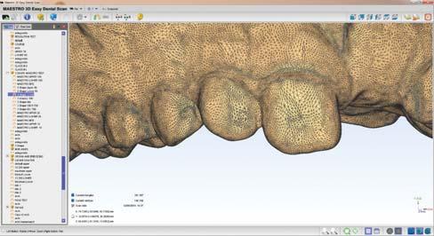 Notice the interdental areas have not been captured well and the software interpolates the data. Figure 7. The rendered model from the scan in Figure 6.