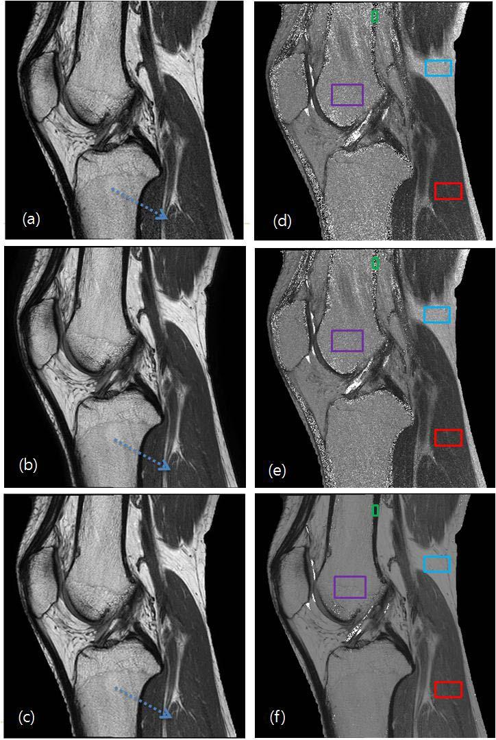 3 Experiments MR imaging was obtained by a 3T MR imager (Intera Achieva Philips Medical Systems, Best, The Netherlands), using a commercially available knee coil (SENSE Knee Coil 3.
