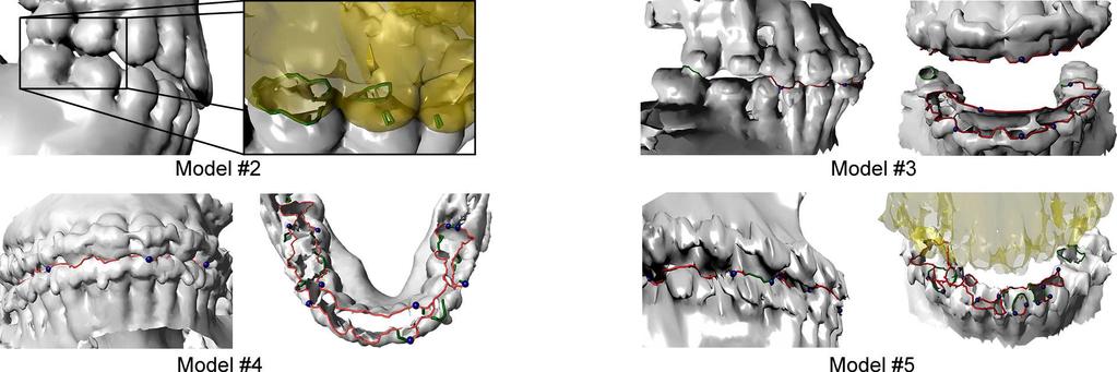 Fig. 6. Segmentation results by our approach: Green curves are the segmentation paths solved by the graph cut, and the semi-transparent yellow region is the upper teeth.