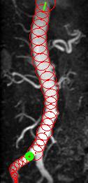 12 Rossignac et al. (a) (b) (c) Fig. 11. Selecting a different branch in bifurcating vasculature.
