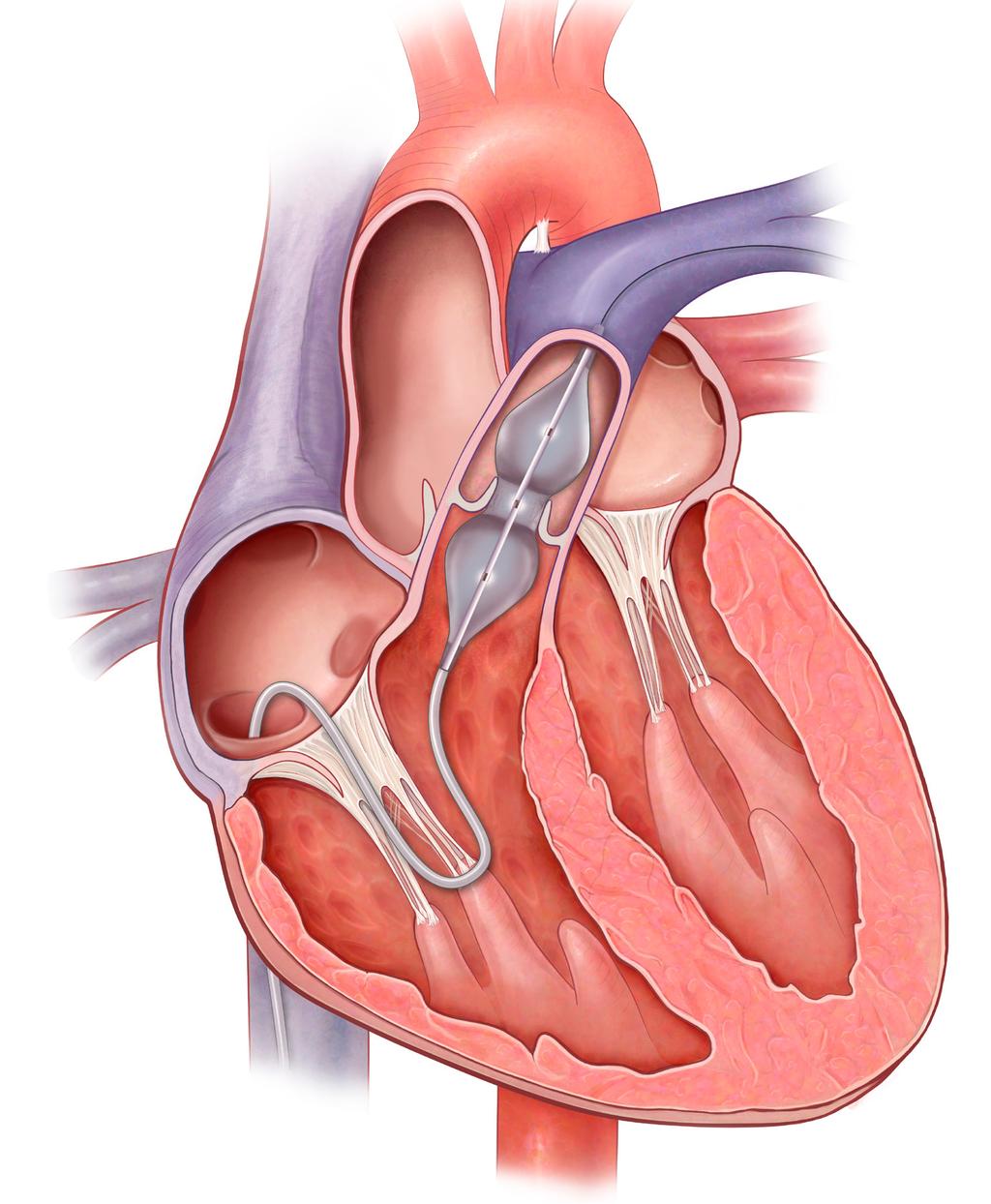 Indications for Use: The PTS and PTS-X Sizing Catheters are recommended for use in those patients with cardiovascular defects wherein accurate measurement of the defect is important to select the