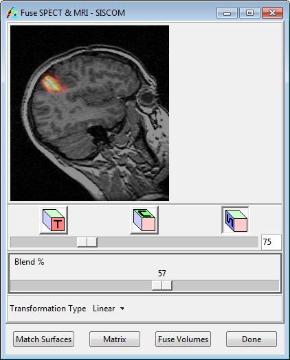 Exercise 49 : SISCOM 6. The Extract MRI Brain tool allows for segmentation of the brain for SPECT-MRI registration. 7. Right-click in the MRI data display window and select the Intensities option.