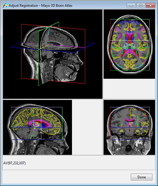 Exercise 50 : Mayo 3D Brain Atlas 12. Select Next to open the Adjust Registration tool (figure 3). If needed the atlas can be adjusted.