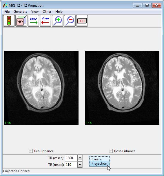Exercise 51 : T2 Projection The MRI T2 Optimization Add-On provides the ability to enhance the relative contrast between different tissue types in T2 weighted MR images postacquistion.