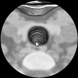 Exercise 21 : Virtual Endoscopy Interactive Generation of Endoscopic Views Virtual Endoscopy is an important visualization application that results from the ability to create 3-D visualizations from