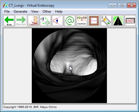 Exercise 22 : Virtual Endoscopy Endoscopic Movie Generation 2.