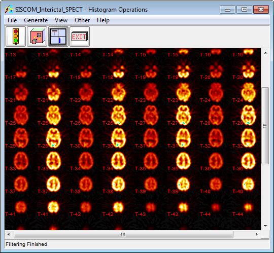 avw and SISCOM_Interictal_SPECT.avw data sets from the $:\BIR\images\TutorialData directory. 2.