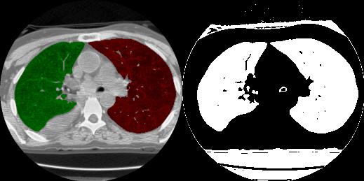 Position the cursor near the center of the left lung and click to set a seed point. 6. The Define Region window will automatically update (figure 1) to display auto trace parameters.