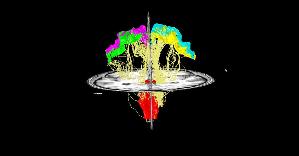 Tractography: