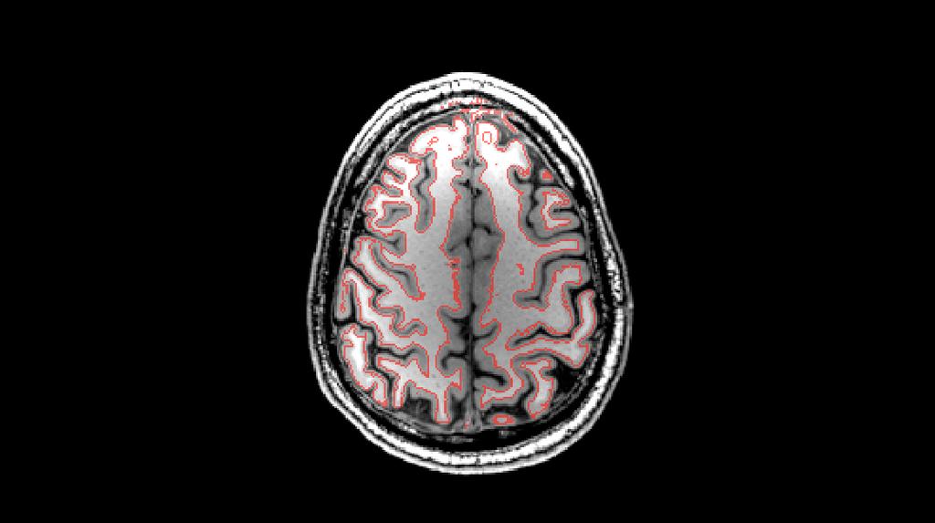Boundary-Based Registration (BBR) EPI to structural registration (Greve & Fischl, NeuroImage, 2009) incorporates fieldmap correction (previously FUGUE) used in FEAT (B0 unwarping) Uses white-matter
