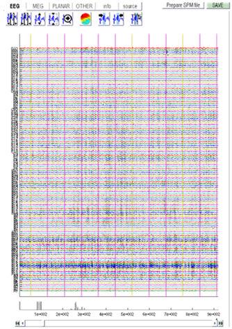 22/04/2014 Conversion Expert s corner MEG CTF Neuromag BTi-4D Yokogawa EEG Convert button (fileio) spm_eeg_convert EEGLAB Biosemi Brainvision Neuroscan EGI ANT SPM5 Biosig GUI Arbitrary ASCII Matlab