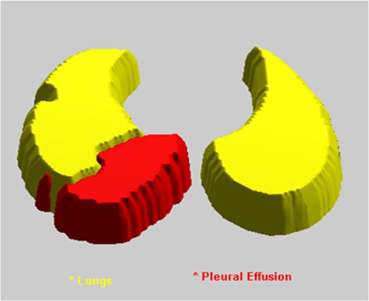 Figure. 7. 3D deformable model of pleural effusion 3. RESULT AND ANALYSIS A method to segment and measure the volume of pleural effusion using chest CT image is proposed.