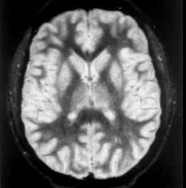 SENSE Brain Image (1999 MRM) Usual