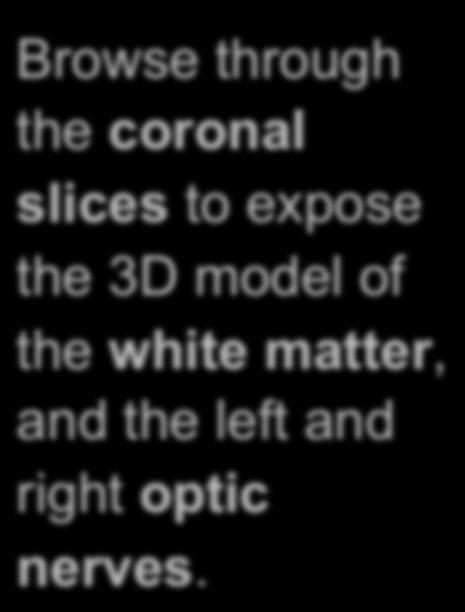 Slicer4 Minute Tutorial: 3D Visualization Browse through the coronal slices to expose