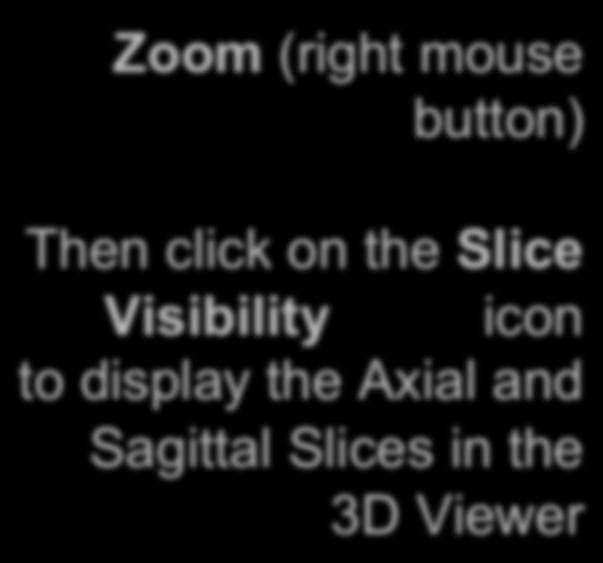 PET/CT Visualization and Analysis: Open the Volume Module Zoom (right mouse button) Then click on