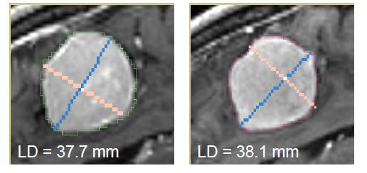 Quantifying tumor change: Conventional measures of tumor response 3D Slicer s
