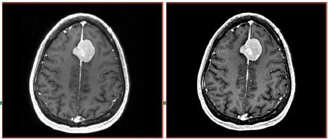 ChangeTracker: about the data This course is built upon two scans of a patient with meningioma: MR Scan 1 MR Scan 2 Please note: we have pre-adjusted the window and level settings for these