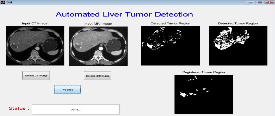 Each set consists of an MRI image and a CT image. For different set of images available, registration has been done.