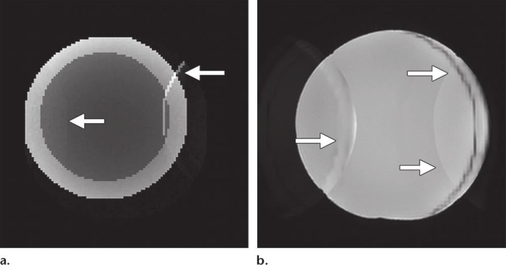 Motion that occurs after calibration scanning results in wrapping of peripheral tissues as a ghost onto more central regions of images (Figs 14, 15).