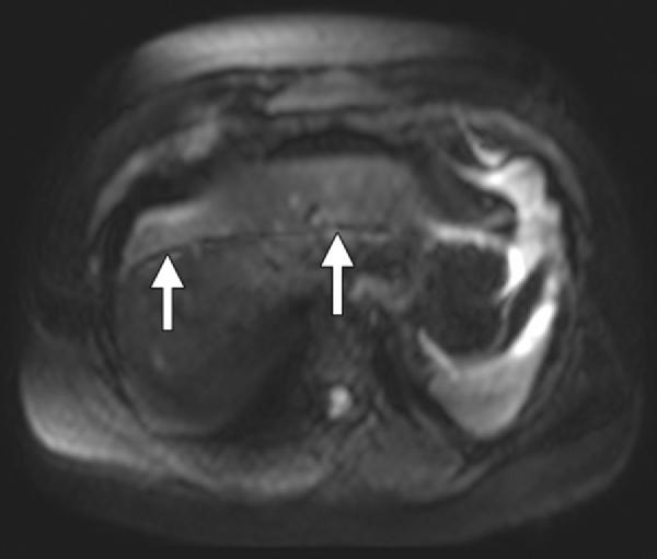 (c) Axial T1-weighted gradient-echo parallel MR image shows the legs near their original position and artifacts (arrows) resulting from disharmony with the second calibration image.