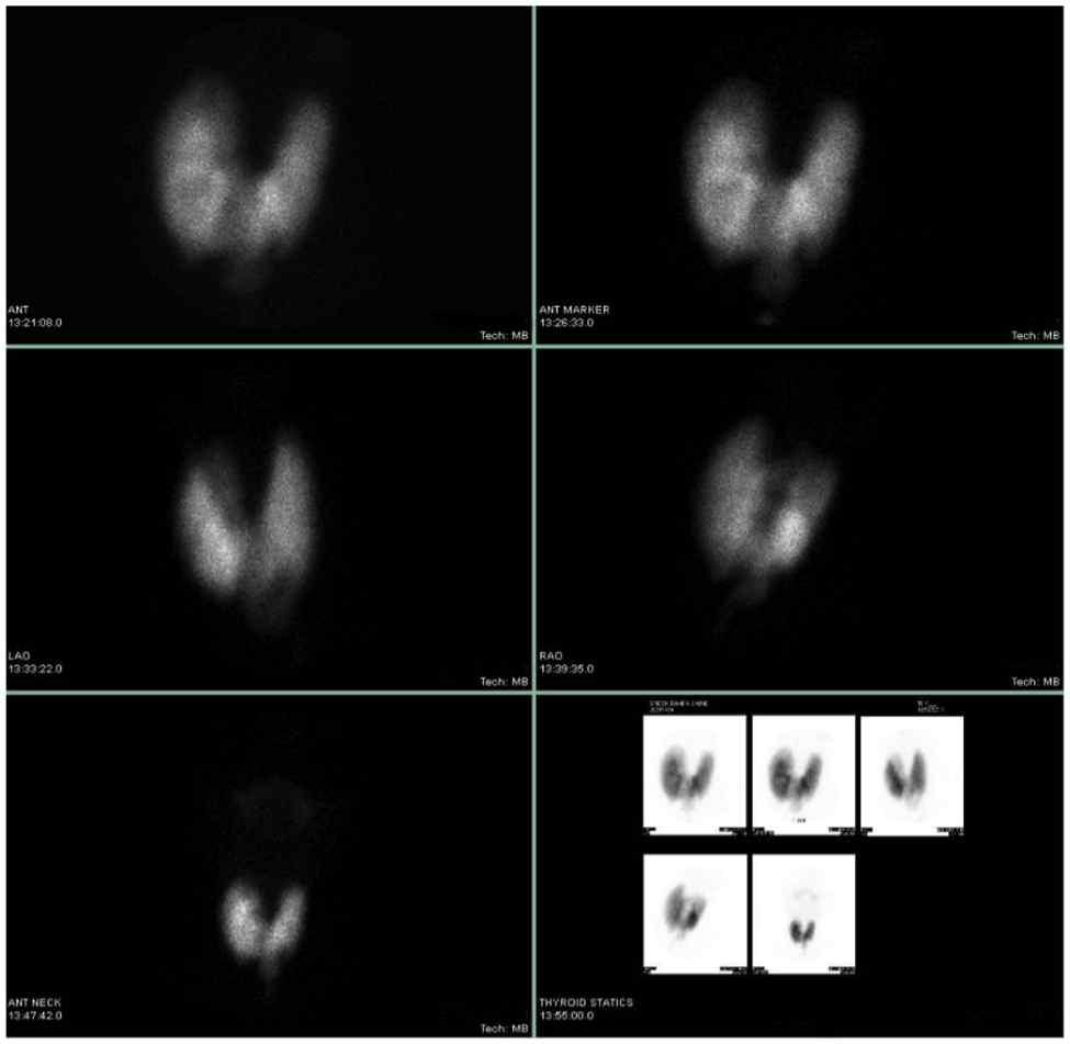 Thyroid Imaging Sample nuclear medicine thyroid images.