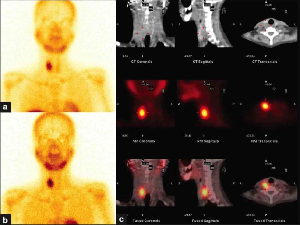 SPECT/CT Thyroid Image Example A 37 YOF with elevated Ca, decreased phosphorus and increased parathyroid hormone (a), (b) early and delayed Tc99m-sestamibi scin/graphs showing uptake