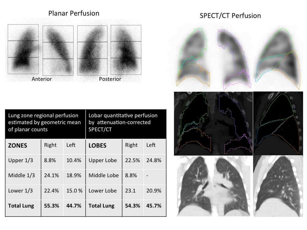 SPECT/CT Lung Perfusion Imaging Tc-99 MAA lung perfusion with planar perfusion (upper left) and SPECT/CT with attenuation correction (upper right).