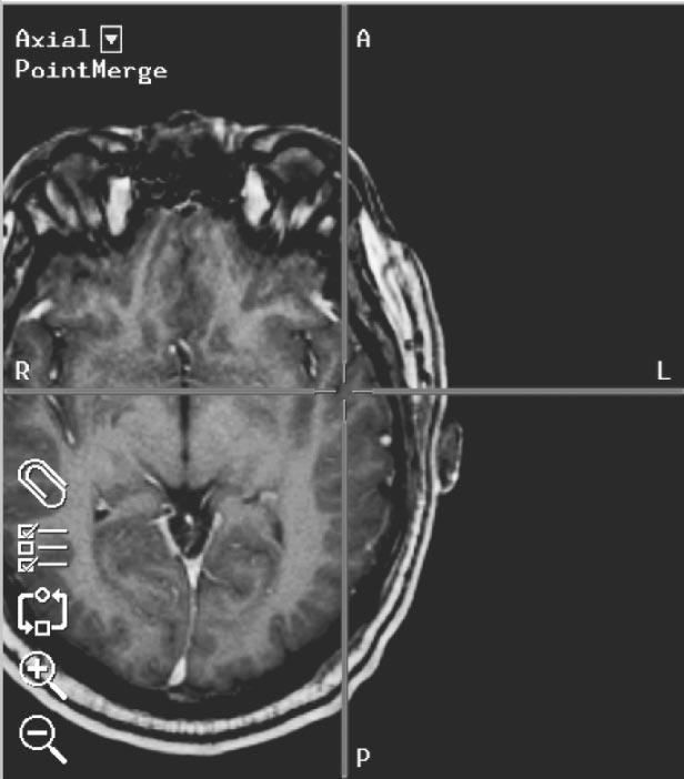 974 IEEE TRANSACTIONS ON MEDICAL IMAGING, VOL. 22, NO. 8, AUGUST 2003 Fig. 1. Example of brain shift seen using an intraoperative image-guided surgery system.