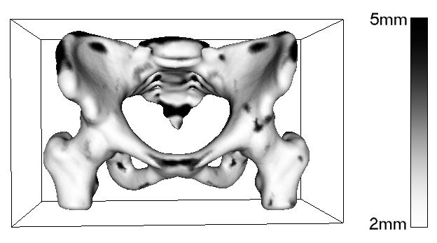 different calcification of bones). Furthermore, the smoothness constrain of the deformation field establishes a compromise between intensity resemblance and uniform local deformations.