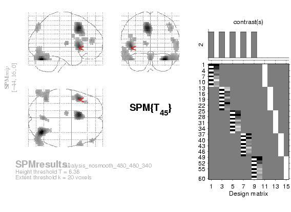 Results In Fig. 6.5, one can see the maximum intensity projection (MIP) of the SPM based on smoothed data (16 mm FWHM).