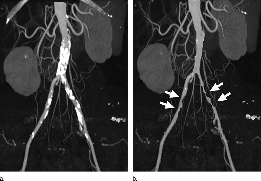 Figure 12 Figure 12: Axial contrast-enhanced, dual-energy scan in a 67-year-old man.